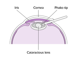 Cataract_procedure_diagram_slide