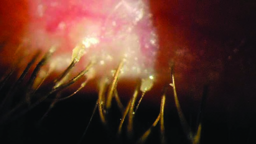 Demodex_showing_collarettes_dsc_0063_web